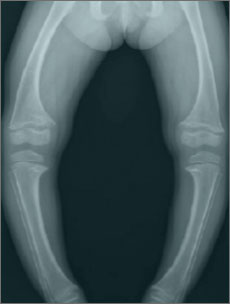 X-linked hypophosphataemia (XLH)